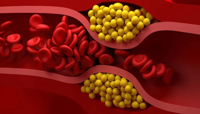 کولیسٹرول کی سطح میں 30 فیصد تک کمی لانے والی انقلابی ویکسین تیار